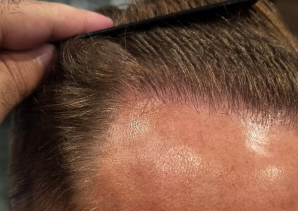 Hair transplant Istanbul: Why is it so popular?
