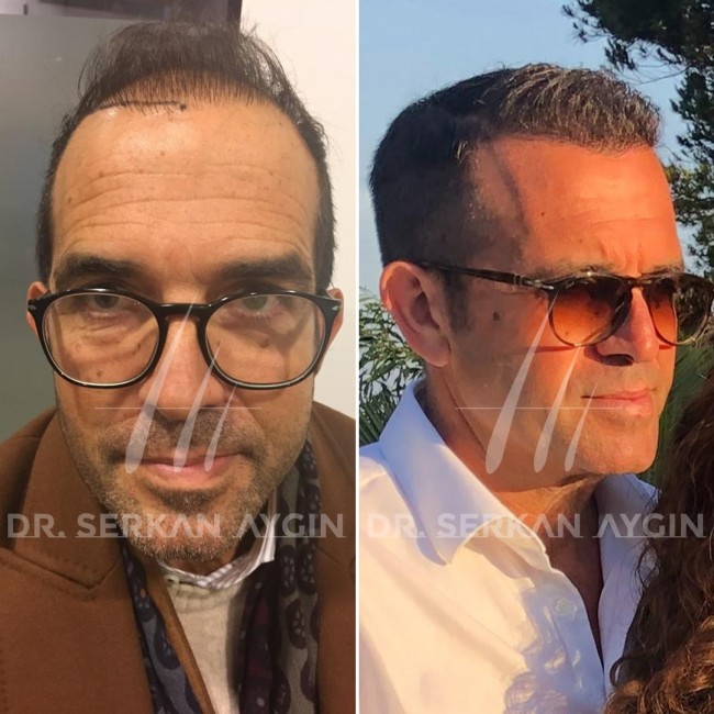 Hair Transplant Istanbul - Why People Everywhere Come to Turkey for Medical Tourism